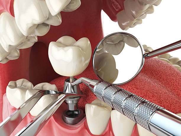 Best Emergency Wisdom Teeth Removal in River Park, FL